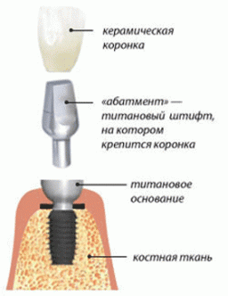 Схема установки имплантанта.